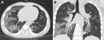 Longitudinal Assessment of Pulmonary Function and Bronchodilator Response in Pediatric Patients With Post-infectious Bronchiolitis Obliterans